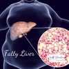 #18 Fatty Liver