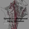 Episode #11 - Hypoglossal Nerve Stimulation