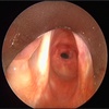 Comparative Outcomes of Treatment Options for Patients With Idiopathic Subglottic Stenosis