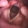 Feasibility of Autologous Adipose Tissue–Derived Stromal Vascular Fraction in Scarred Vocal Folds