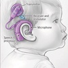 Use of Diagnostic Testing and Intervention for Sensorineural Hearing Loss in US Children