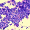 Thyroid Cancer Active Surveillance Program Retention and Adherence in Japan
